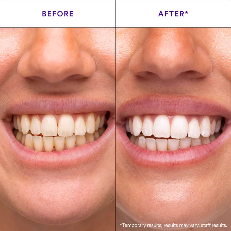 Teeth Whitening Strips — Whiter Teeth in Just 30 Minutes